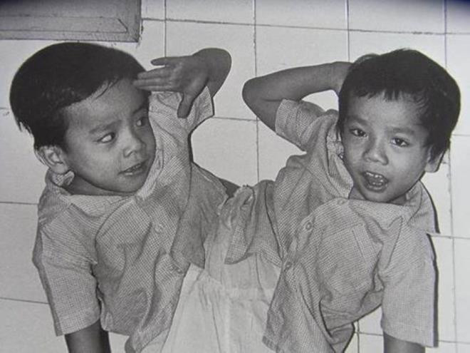 Hai anh em Việt - Đức lúc còn bị dính liền.