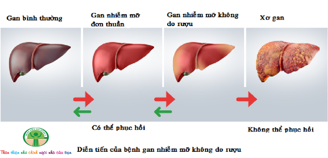 Nếu phát hiện, can thiệp hỗ trợ trễ trẻ bị gan nhiễm mỡ sẽ đối mặt với những nguy hiểm do xơ gan (đồ họa: BV Nhi Đồng 2).