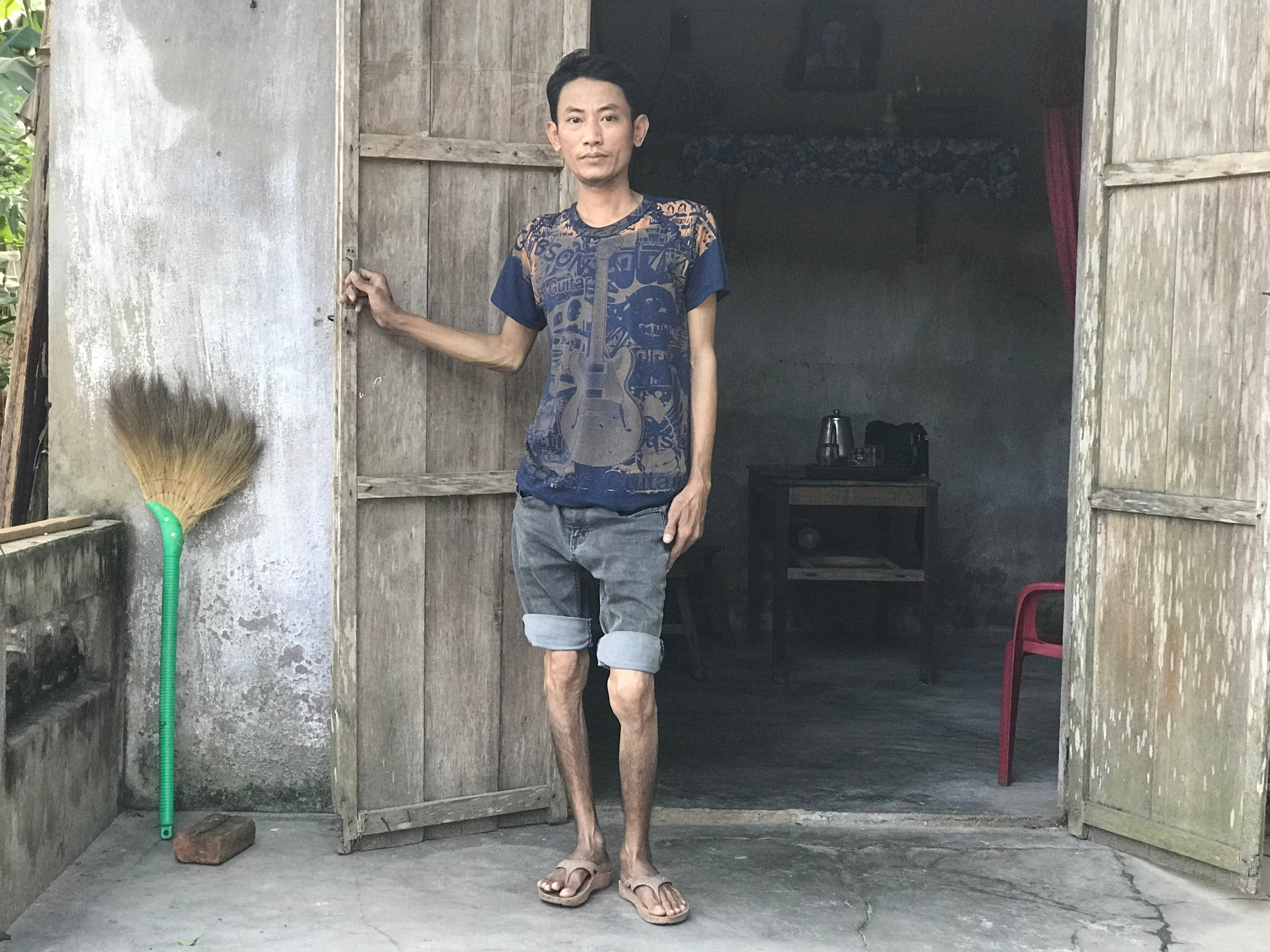 Sau tai nạn, anh Hoàng Văn Tuấn chân thấp, chân cao và ngày càng teo nhỏ lại.