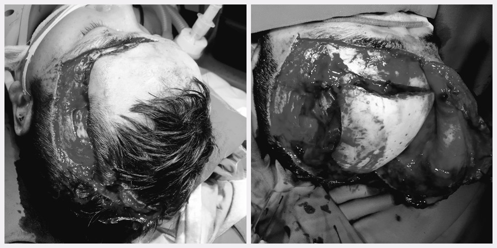 Bệnh nhân nhập viện với chấn thương sọ não nặng, rách da đầu phức tạp. Ảnh do bệnh viện cung cấp.