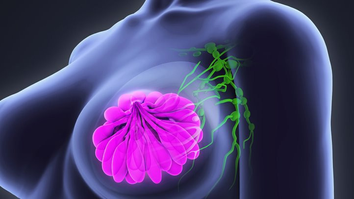 Ung thư vú có thể chữa khỏi 100% nếu được phát hiện ở giai đoạn tiền lâm sàng.