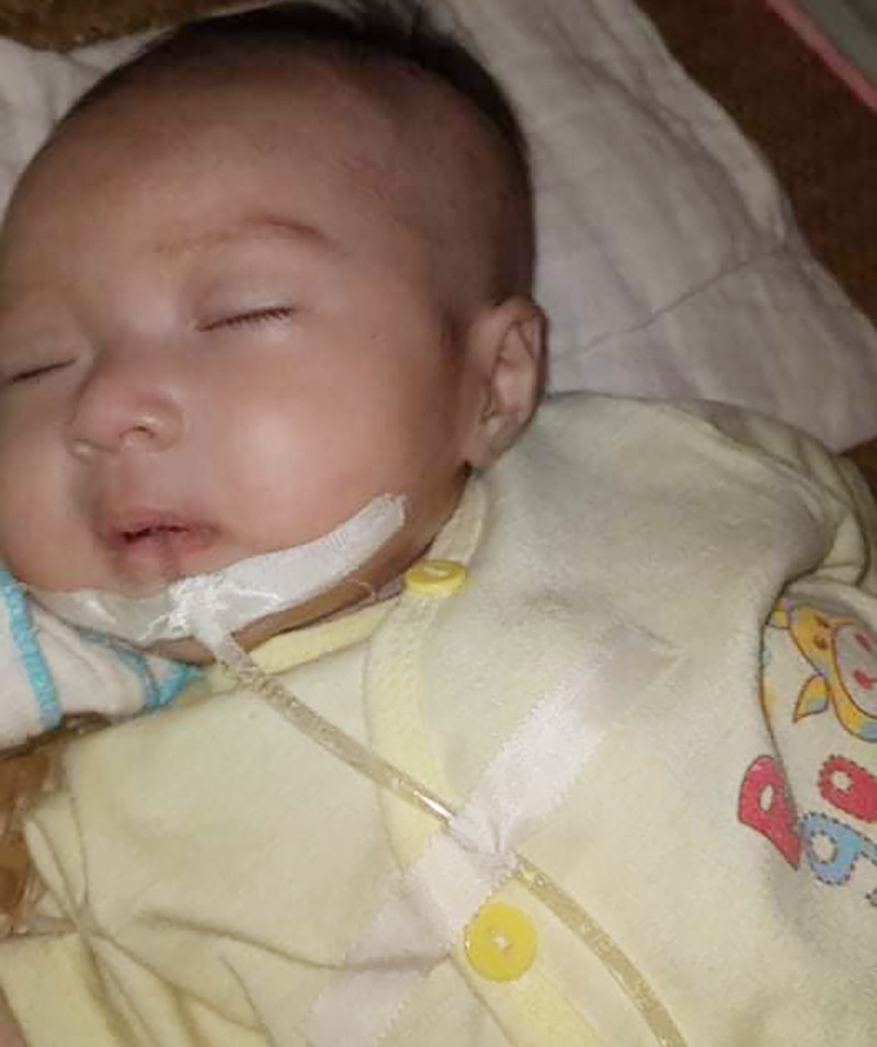 Cháu Nguyễn Thị Thuỳ Ân mới 2 tháng tuổi đã trải qua 2 lần phẫu thuật để điều trị bệnh Teo ruột.