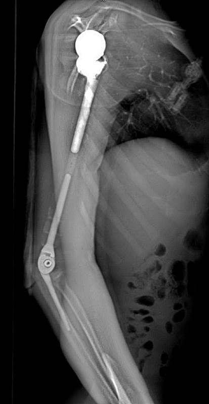 Ảnh chụp X-quang so sánh xương cánh tay 2 bên sau khi phẫu thuật.