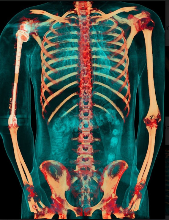 Ảnh chụp X-quang so sánh xương cánh tay 2 bên sau khi phẫu thuật.