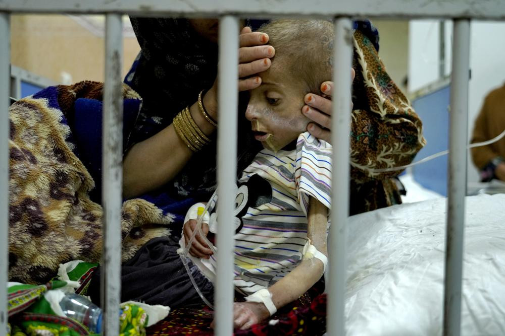 Những đứa trẻ suy dinh dưỡng nghiêm trọng ở Afghanistan. Ảnh: AP.