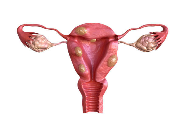 U xơ tử cung là bệnh lý thường gặp ở nữ giới trong độ tuổi sinh sản.