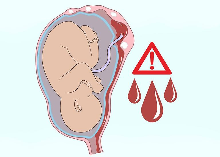 U xơ tử cung dễ gây sảy thai, sinh non (Ảnh minh họa).