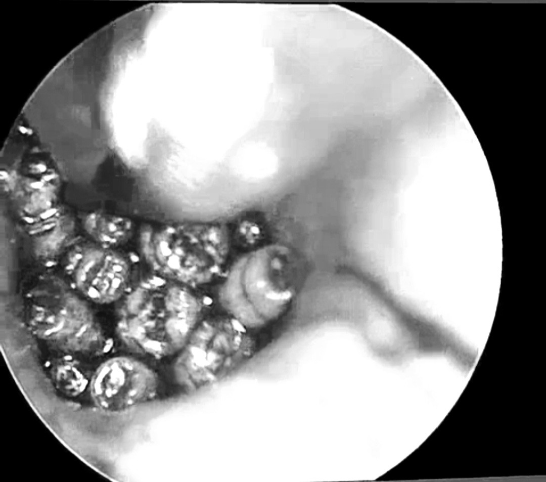 Phát hiện hàng chục con giòi sống trong tai giữa của một bệnh nhân.