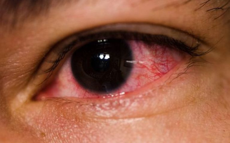 Những ngày qua ngành y tế thành phố cũng ghi nhận, số ca mắc bệnh đau mắt đỏ gia tăng.