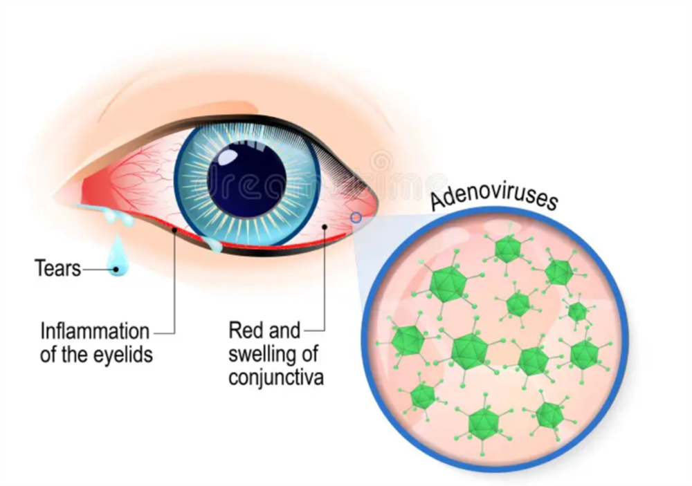 Ngành y tế TP HCM tìm thấy 2 tác nhân chủ yếu gây bệnh đau mắt đỏ hiện nay.