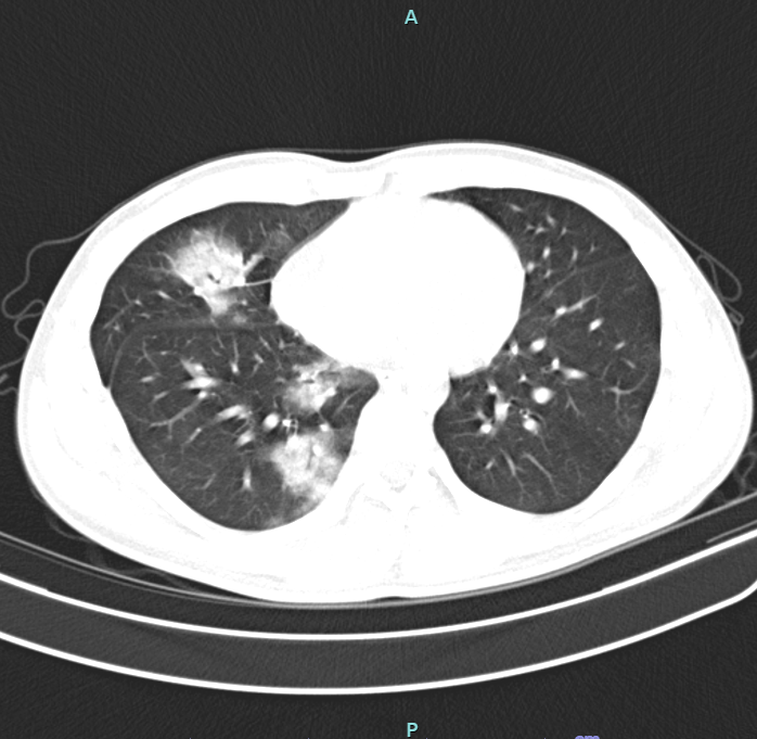 Phim chụp cắt lớp vi tính của người bệnh cho thấy tổn thương thâm nhiễm rộng thùy dưới phổi phải