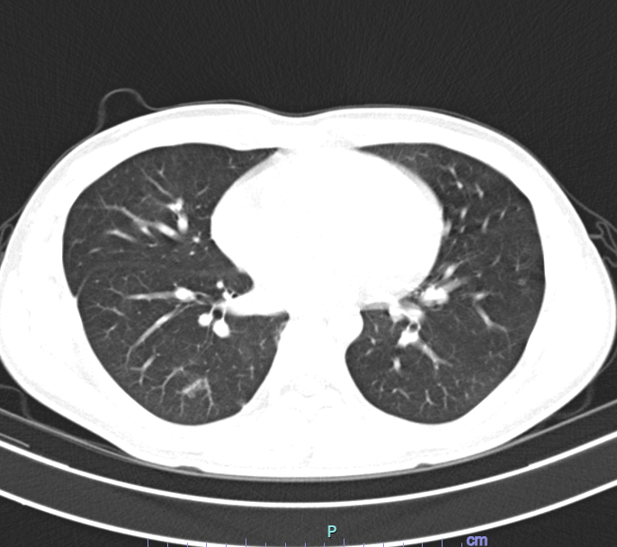 Phim chụp cắt lớp vi tính của người bệnh sau khi điều trị cho thấy tổn thương phổi đã cải thiện